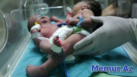 Ukraynada iki başlı qız doğulub